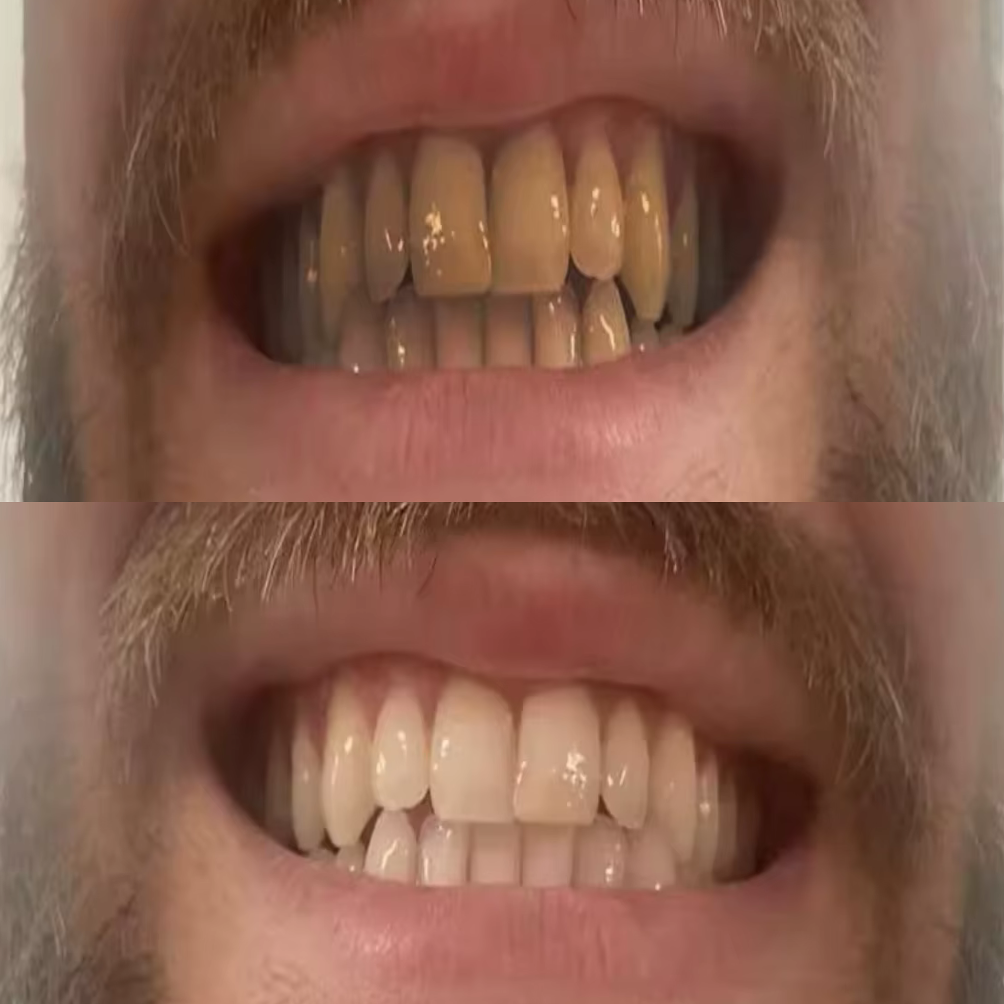 Daniel 39 Years old EcoBrightSmile Before After Natural Tooth Whitener Powder