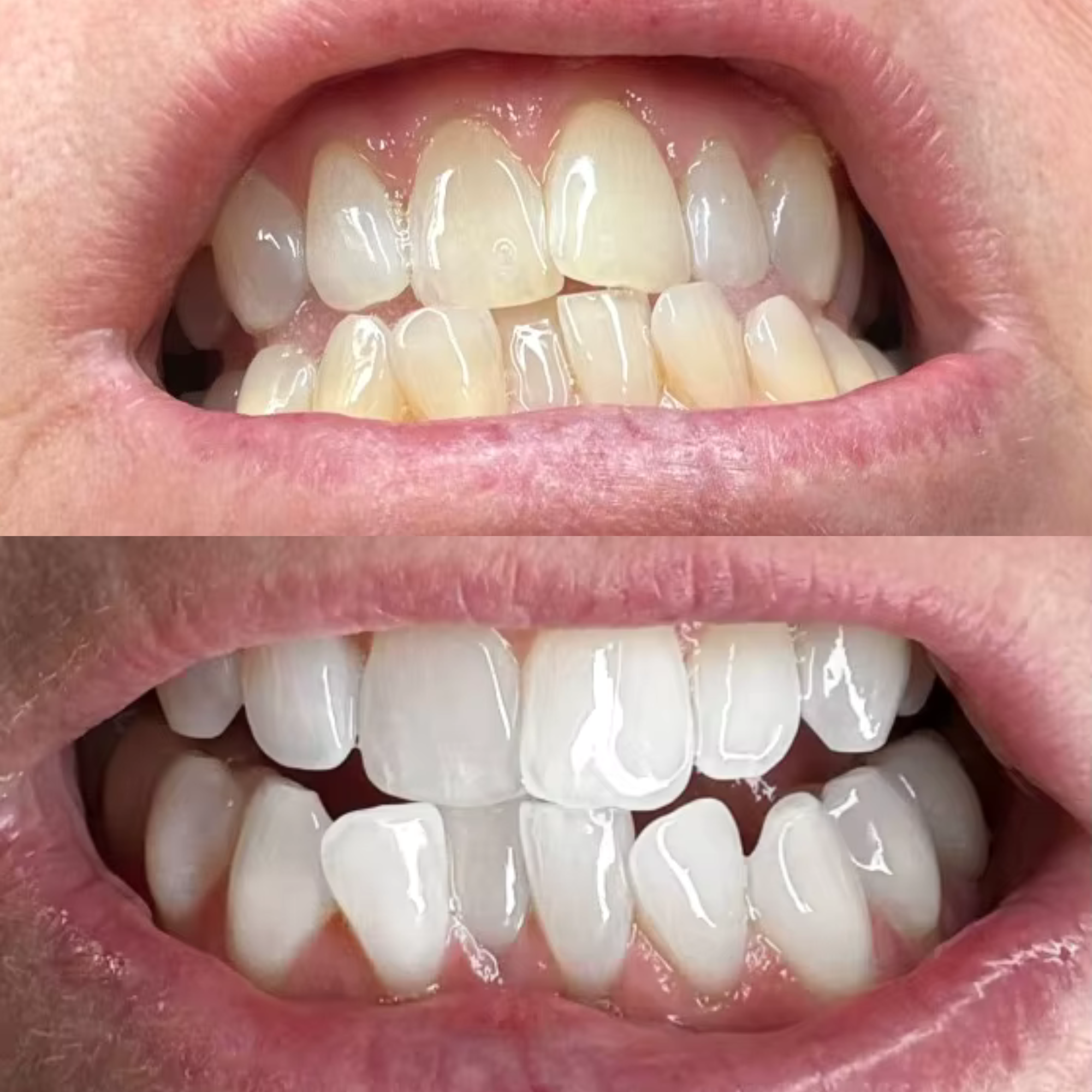 Helen 57 Years old EcoBrightSmile Before After Teeth Whitening