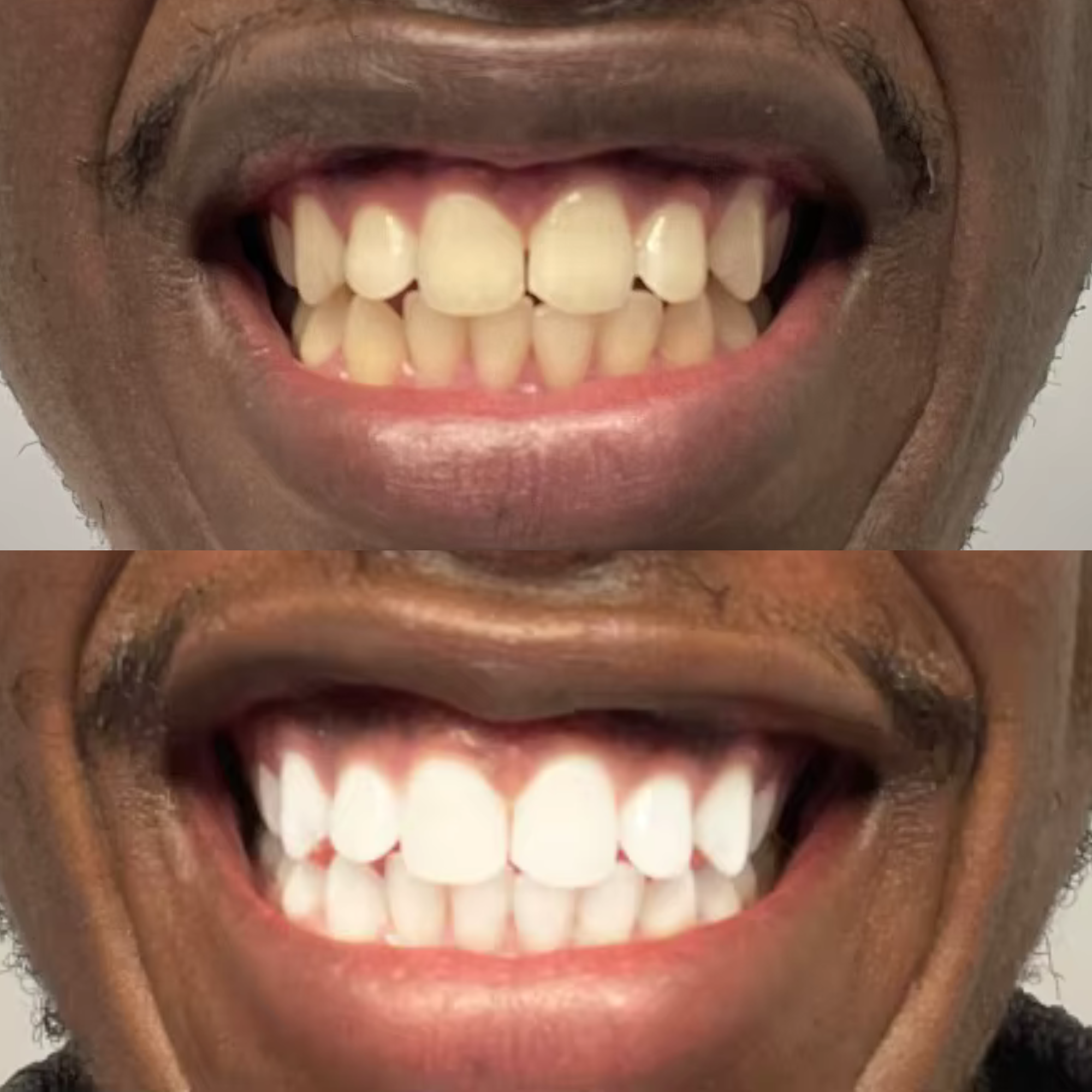 James 47 Years old Eco Bright Smile Before After Natural Teeth Whitening