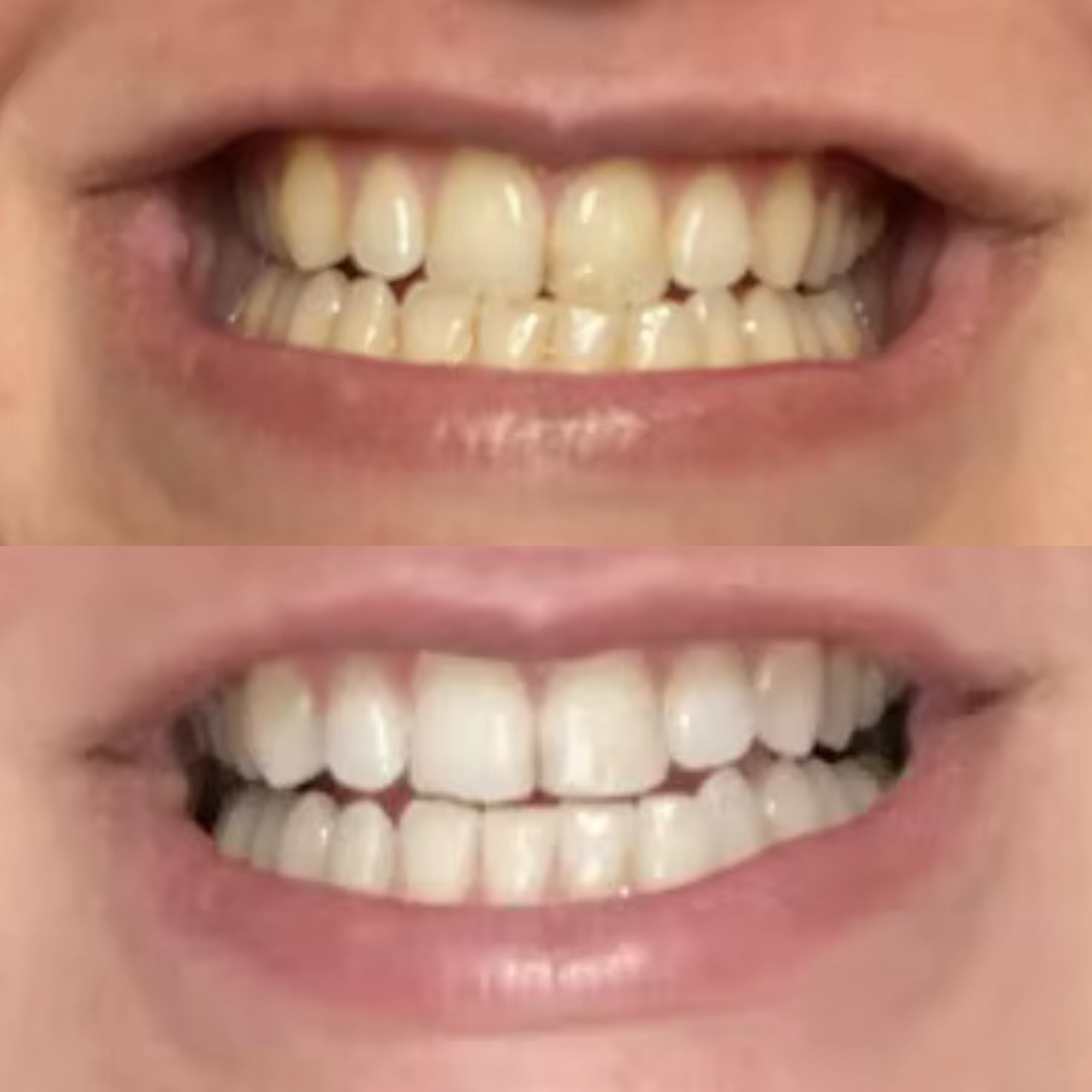 Laura 40 Years old EcoBrightSmile Before After Natural Teeth Stain Remover