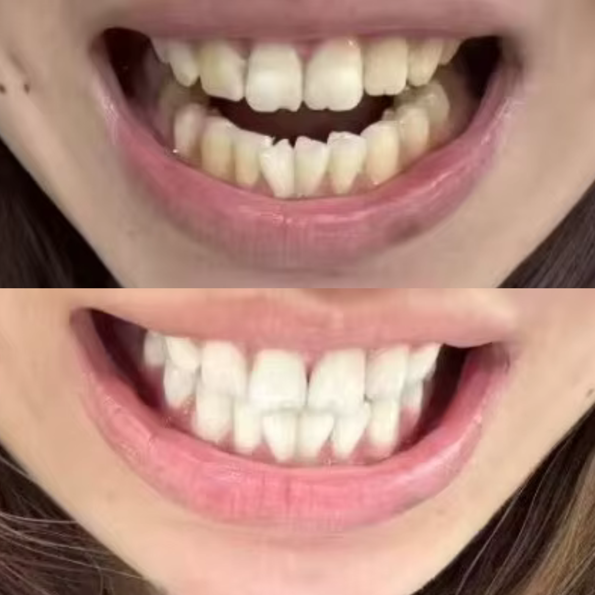 Sarah 27 Years old EcoBrightSmile Before After Tooth Whitening Powder