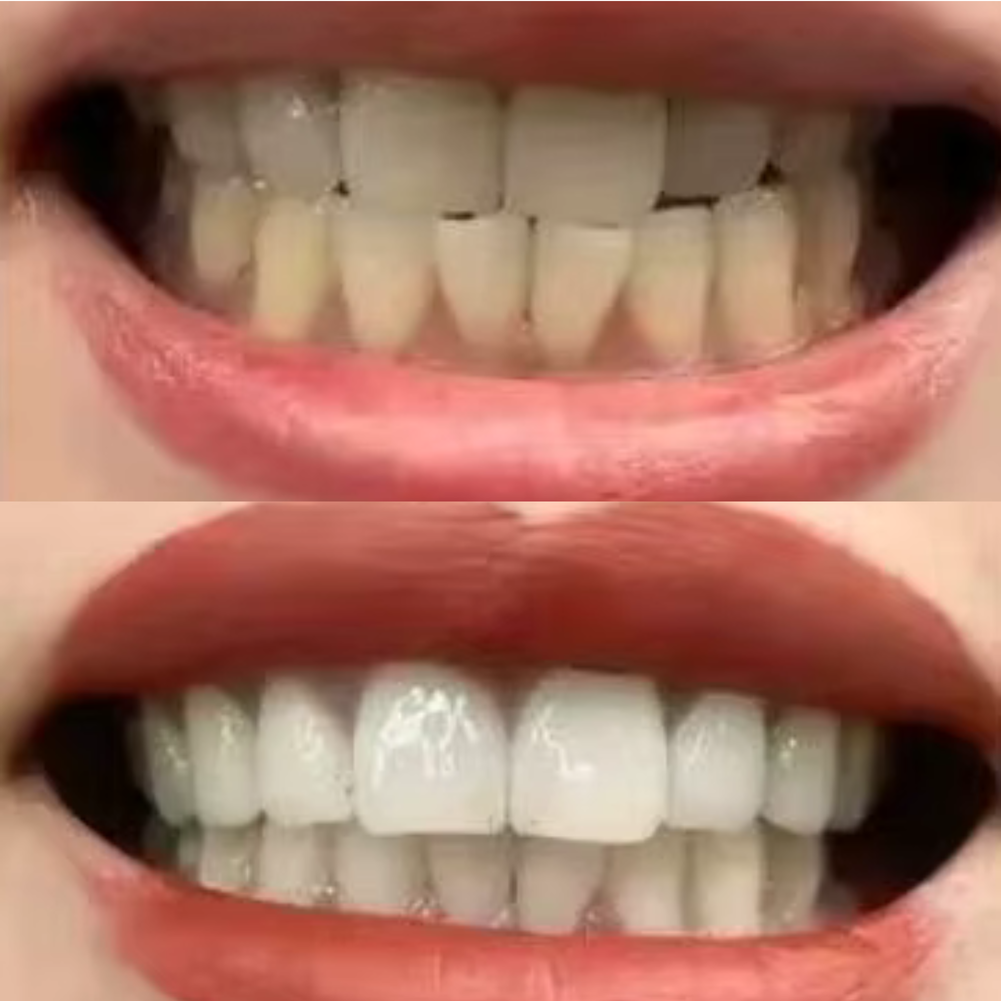 Sophie 36 Years old EcoBrightSmile Before After Natural Tooth Whitening Powder