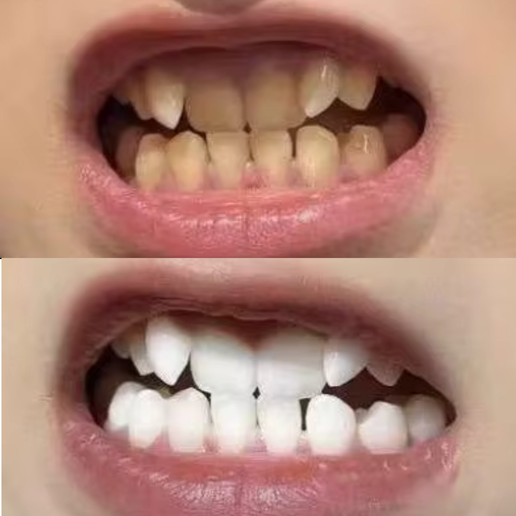  June 31 Years old Eco Bright Smile Before After Natural Teeth Whitening