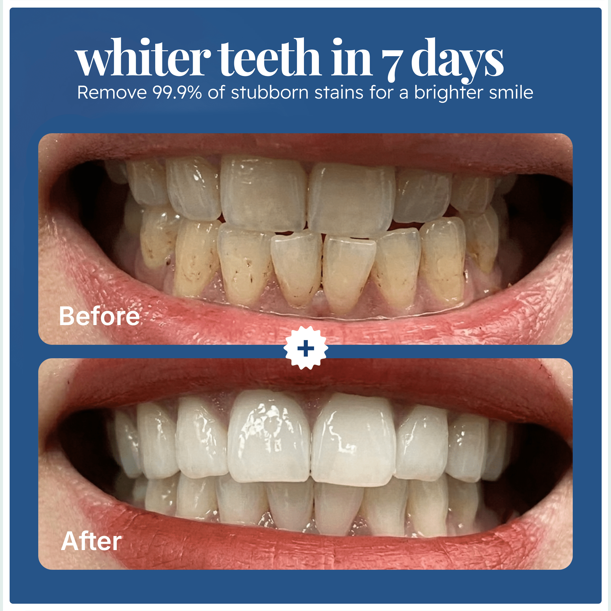 Before and after photo showing teeth whitening results after 7 days using EcoBrightSmile powder